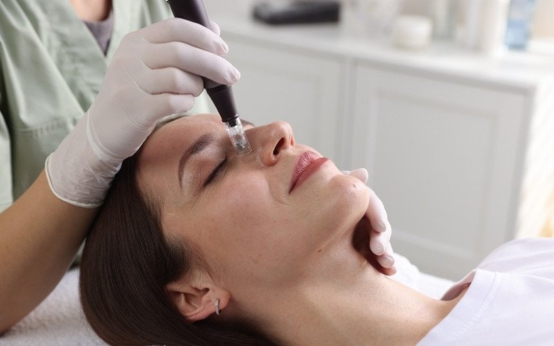 Microneedling
