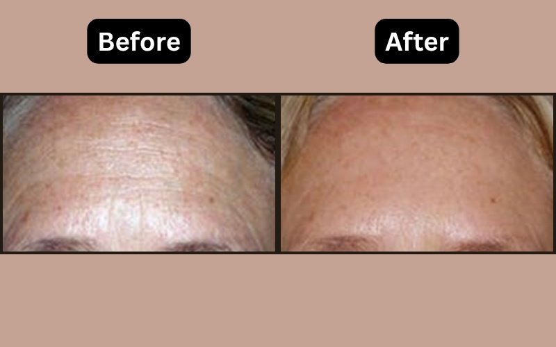 Microneedling Before & After